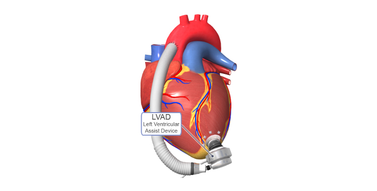 left-ventricular-assist-device